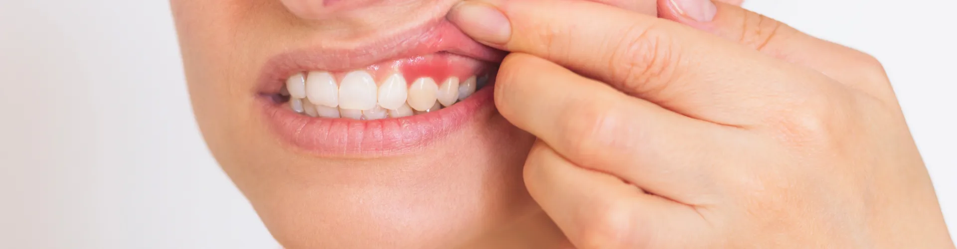 Woman lifting upper lip to reveal inflamed gums.