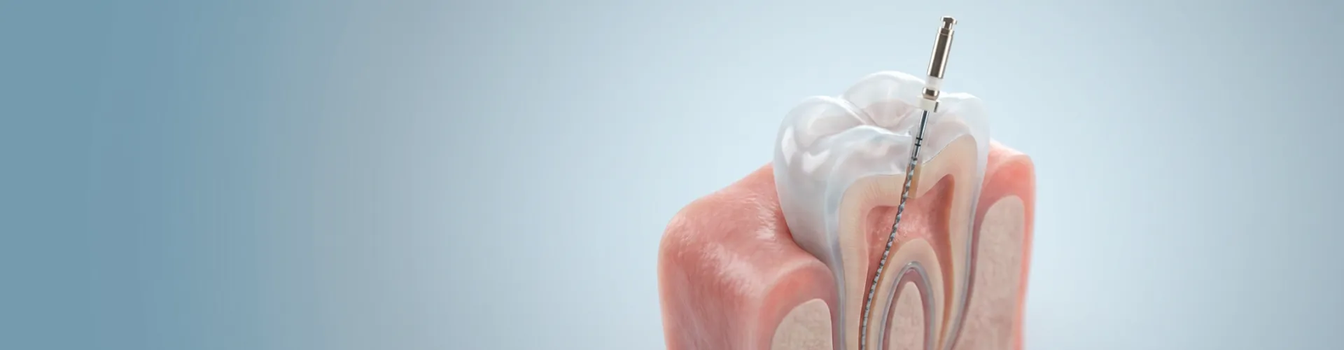 3D illustration of a root canal procedure showing an endodontic file inserted into the tooth’s root canal.
