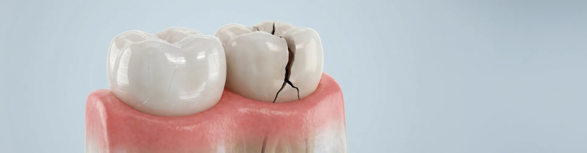 3D illustration of a cracked molar with a deep fracture extending toward the gumline.