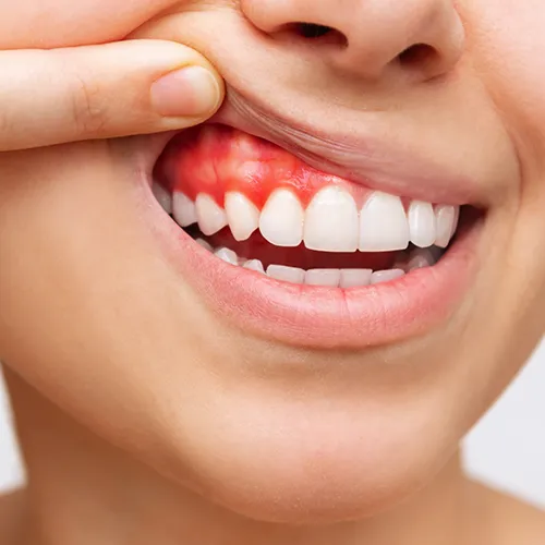 woman lifting lip to reveal red gums
