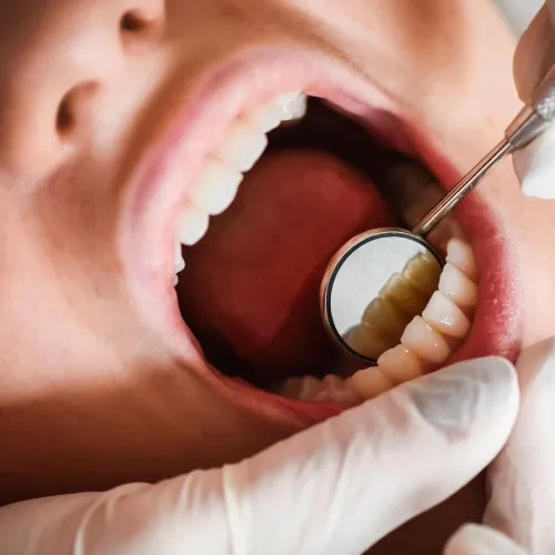 Gloved hands holding dental mirror in patient's mouth.