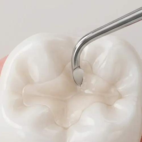 Close-up of a tooth undergoing dental bonding, with composite resin being carefully shaped to restore the tooth's natural contours.
