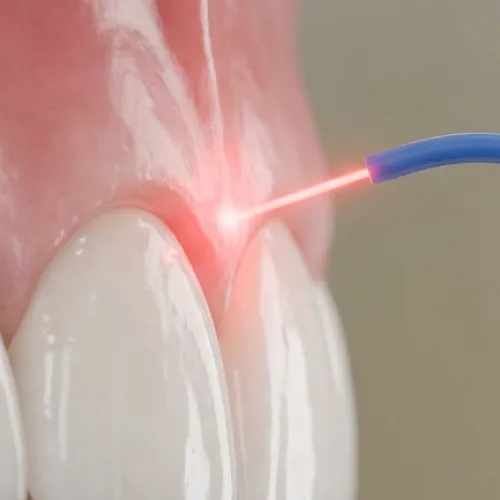 Rendering of a dental laser being used to contour a gumline.