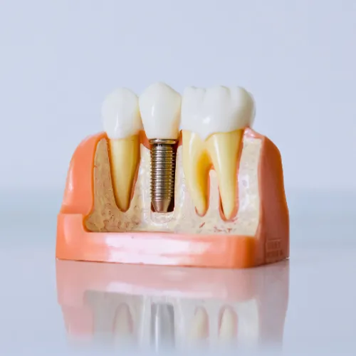 Dental implant between teeth in jaw model.