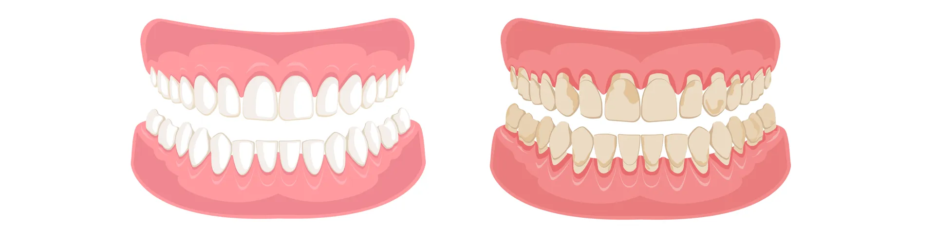 Illustration of two dentures: one white and clean, the other yellowish and less cared for.