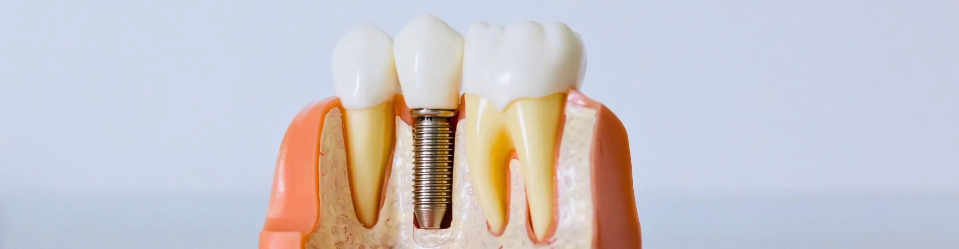 Dental implant between teeth in jaw model.