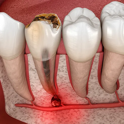 rendering of an infected tooth