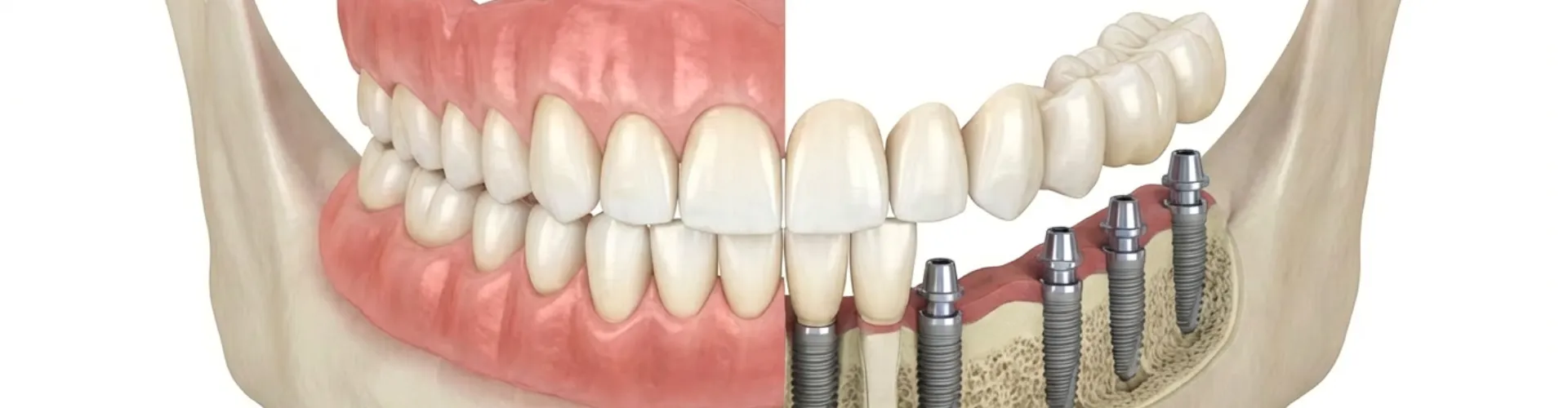 Rendering of a side-by-side comparison of a mouth with no gums on one side revealing implants.