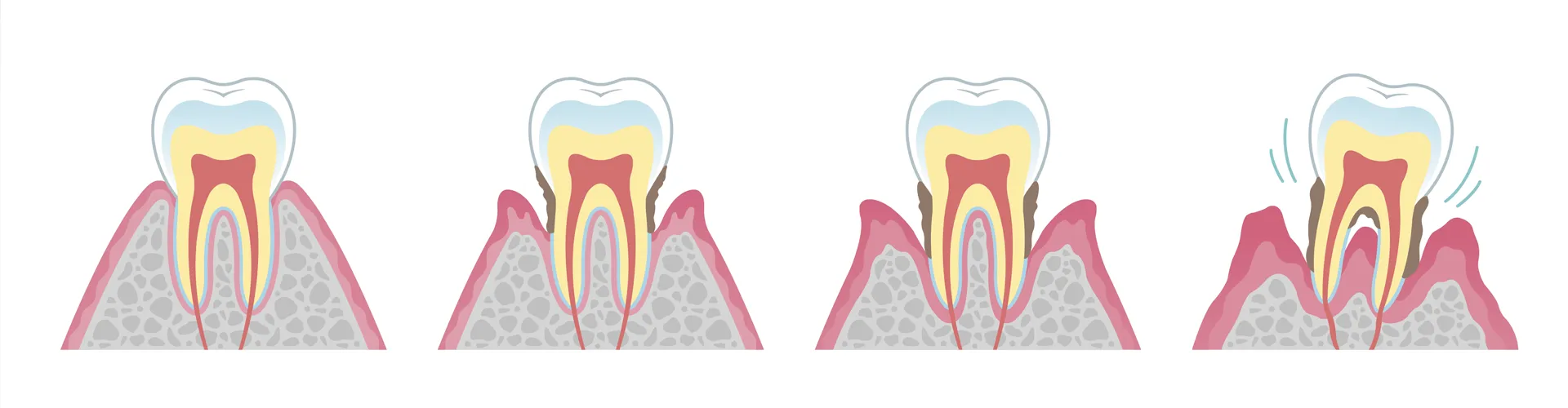 Illustration of four teeth showing the stages of teeth loosening due to plaque.