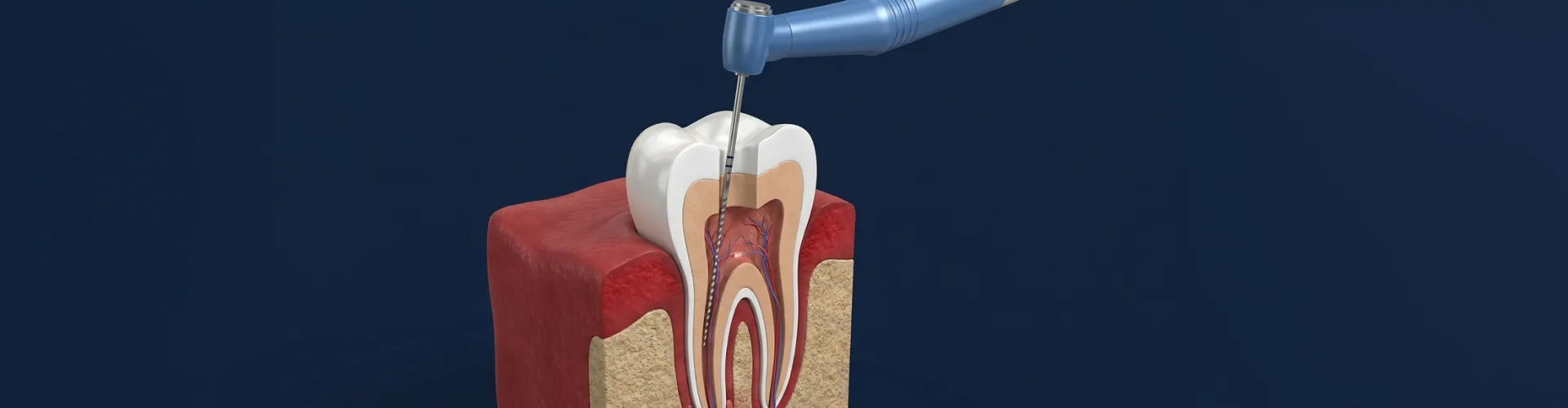 3D dental illustration showing a root canal instrument cleaning the inside of a tooth, highlighting root canal retreatment at Akemi Dental Specialists.