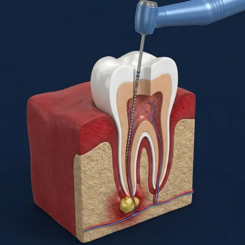 3D dental illustration showing a root canal instrument cleaning the inside of a tooth, highlighting root canal retreatment at Akemi Dental Specialists.