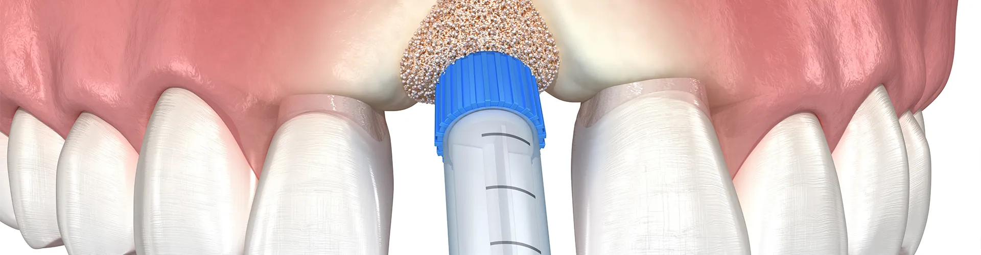 Rendering of a graft being placed into tooth socket.