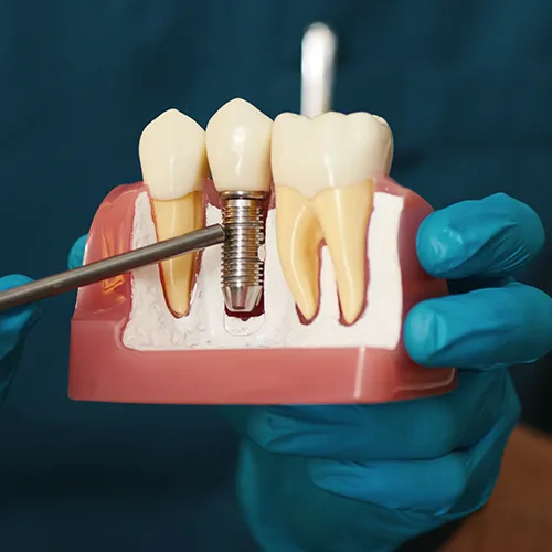 Gloved hands holding a model with an implant between two teeth.