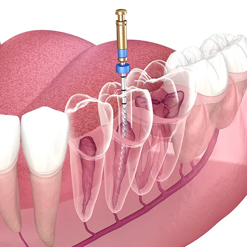 Rendering of a root canal tool inside a tooth.