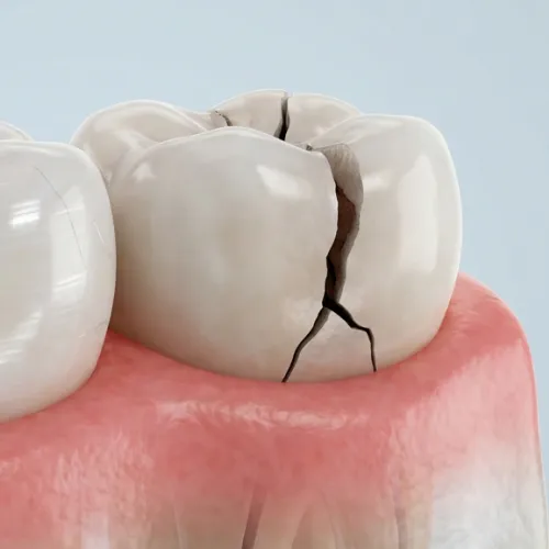 3D illustration of a cracked molar with a deep fracture extending toward the gumline.
