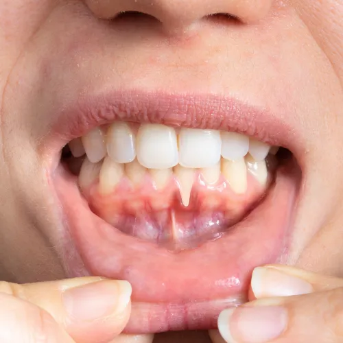Woman pulling down bottom lip to show damaged gum.