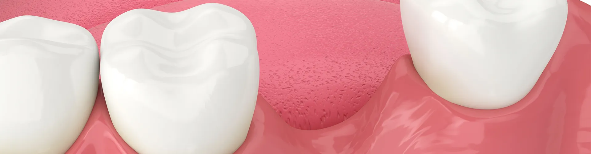 Rendering of a gap between two teeth.