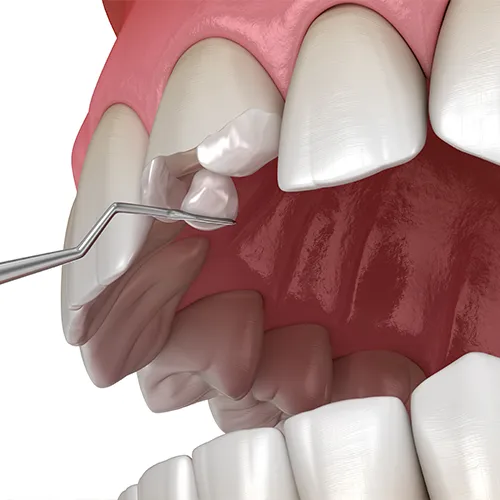 rendering of material being aded to recontour a chipped tooth
