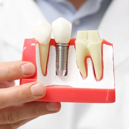 Dentist holding a dental implant model to explain candidacy and procedure to a patient.