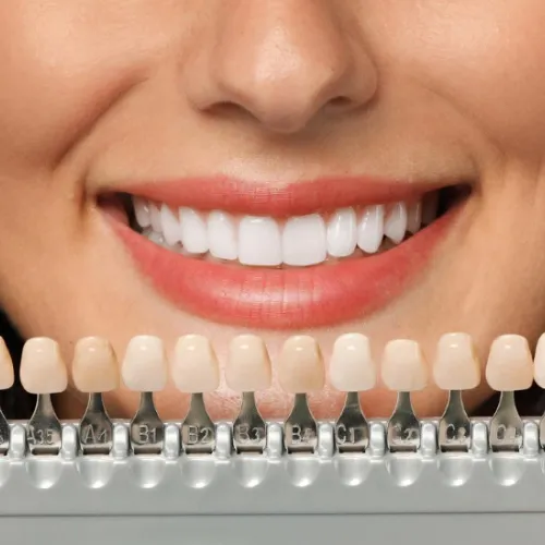 Smiling woman holding a dental shade guide in front of her bright white teeth to compare tooth color for cosmetic veneer treatment.