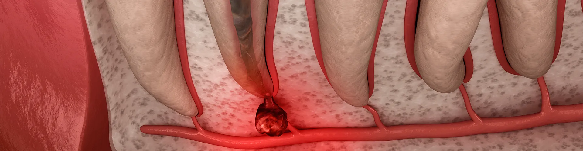 Rendering of an infected tooth.