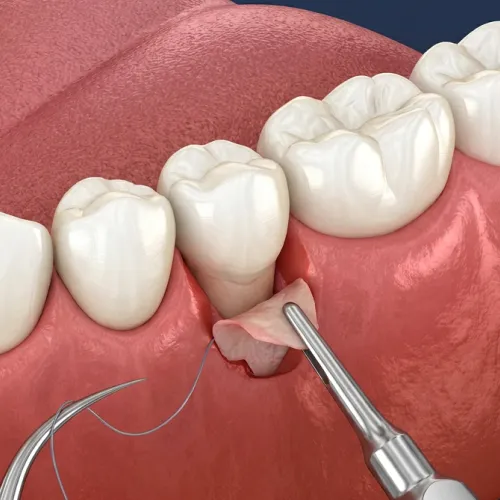 Rendering of a graft being placed on the gum below a tooth.2