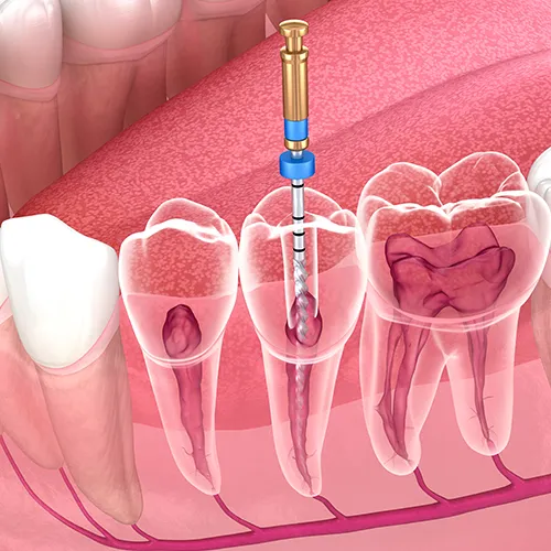 rendering of a lower jaw with root canal tool inside tooth