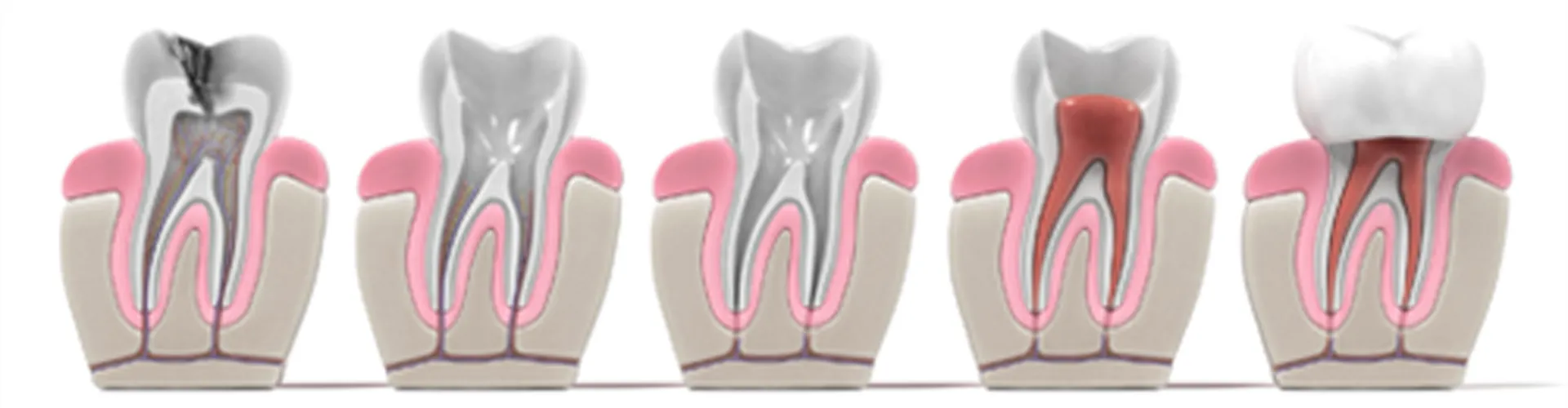 Illustration of five teeth showing the different internal parts of a tooth.