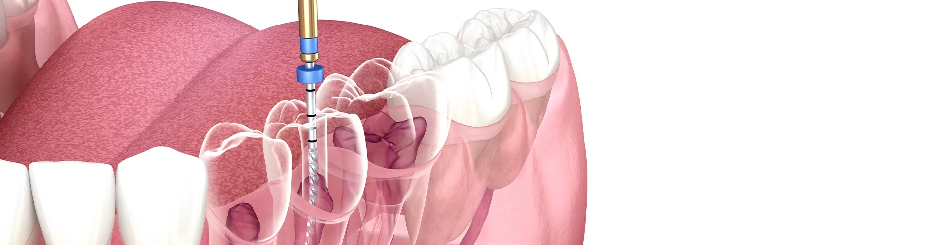 Rendering of a root canal tool inside a tooth.