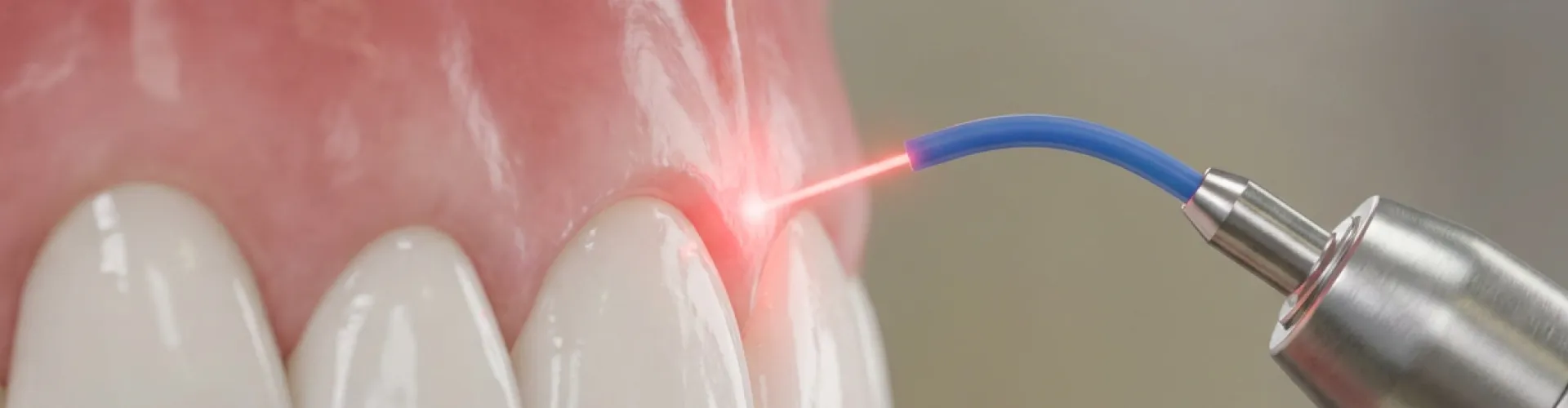 Rendering of a dental laser being used to contour a gumline.