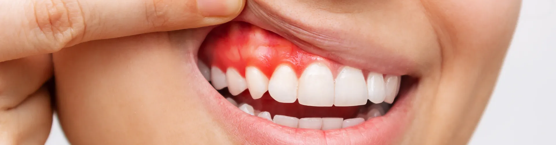 Woman lifting lip to reveal red gums.
