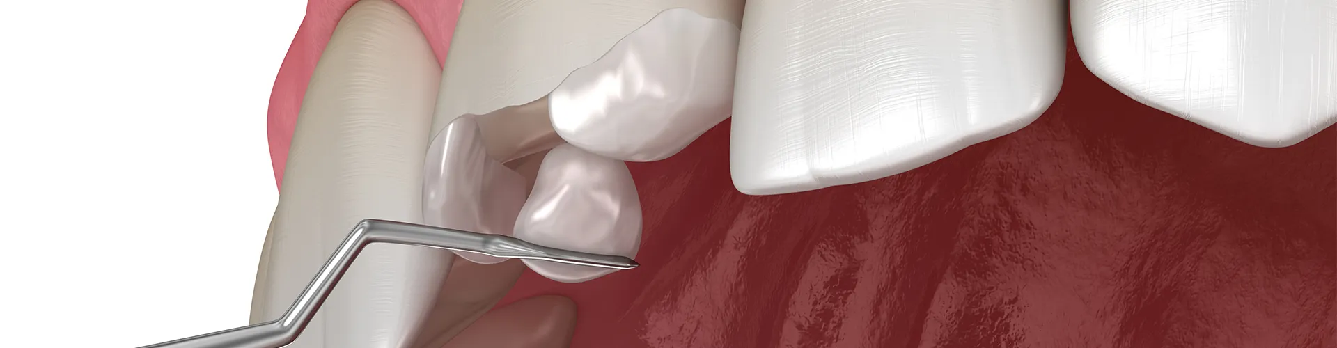 Rendering of material being aded to recontour a chipped tooth.