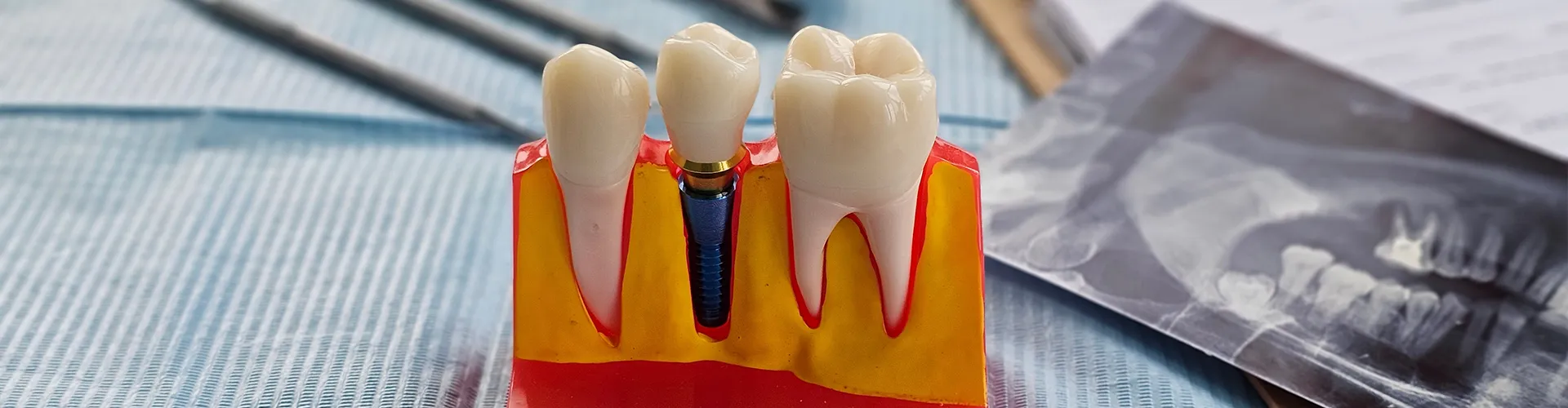 Model of an implant between two teeth.