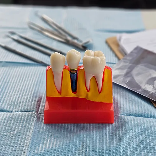 Model of an implant between two teeth.