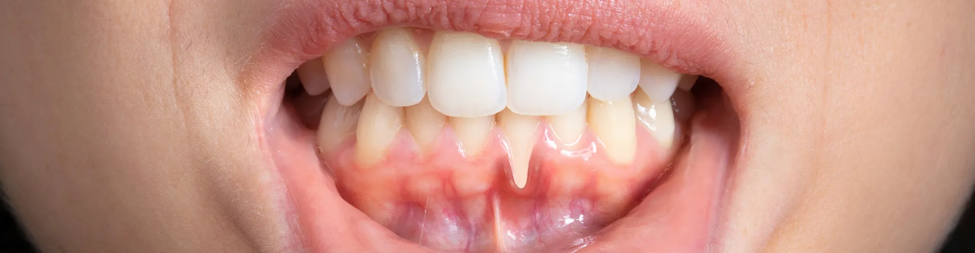 Woman pulling down bottom lip to show damaged gum.