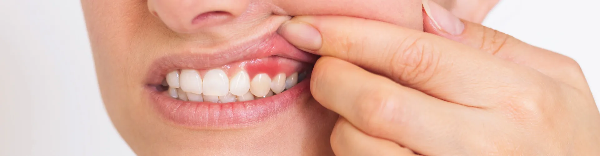 Woman lifting her lip to show gums.