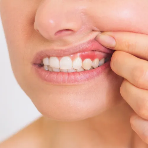 Woman lifting upper lip to reveal inflamed gums.