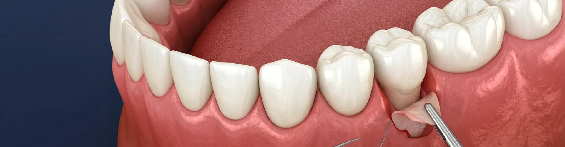 Rendering of a graft being placed on the gum below a tooth.2