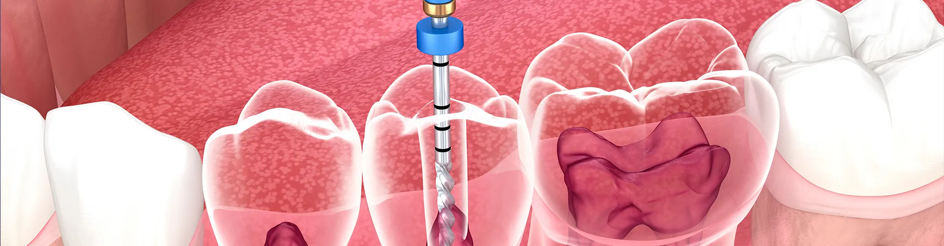 Rendering of a lower jaw with root canal tool inside tooth.